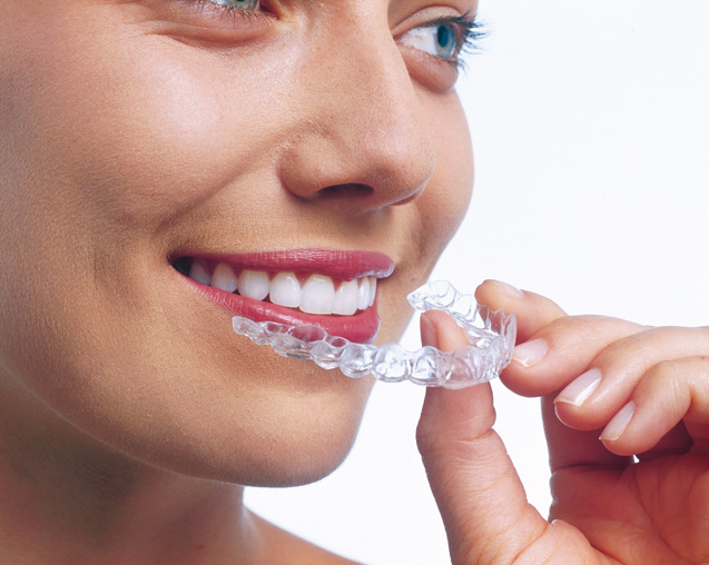 Niềng răng Invisalign là phương pháp “niềng răng” bằng những chiếc khay trong suốt gần như vô hình 