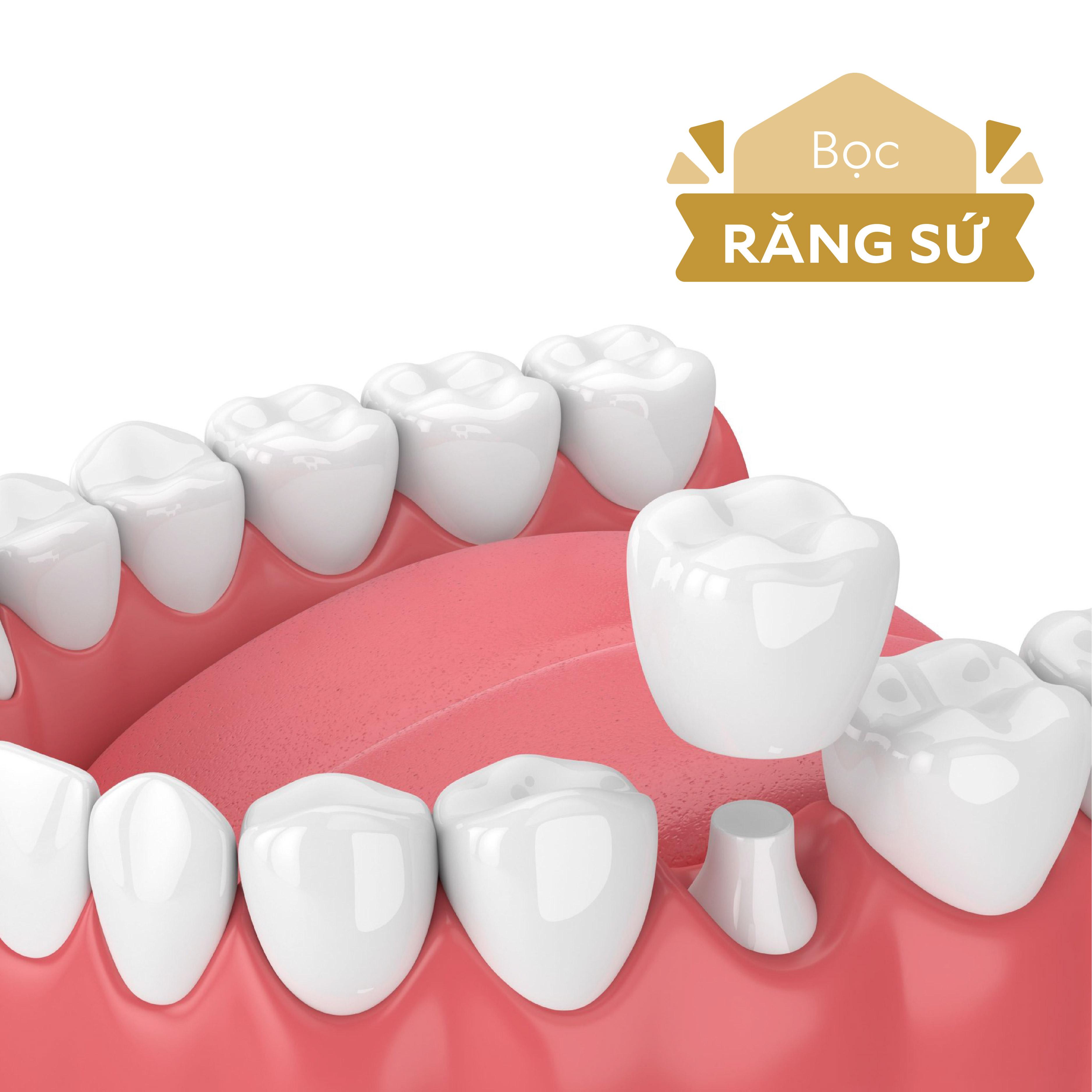Bọc răng sứ áp dụng cho các vấn đề răng như: răng đen sậm, ố vàng, răng bị sứt mẻ, sâu nặng hay bị mất gần như toàn bộ phần ngoài của răng, hô móm khớp cắn không tốt.