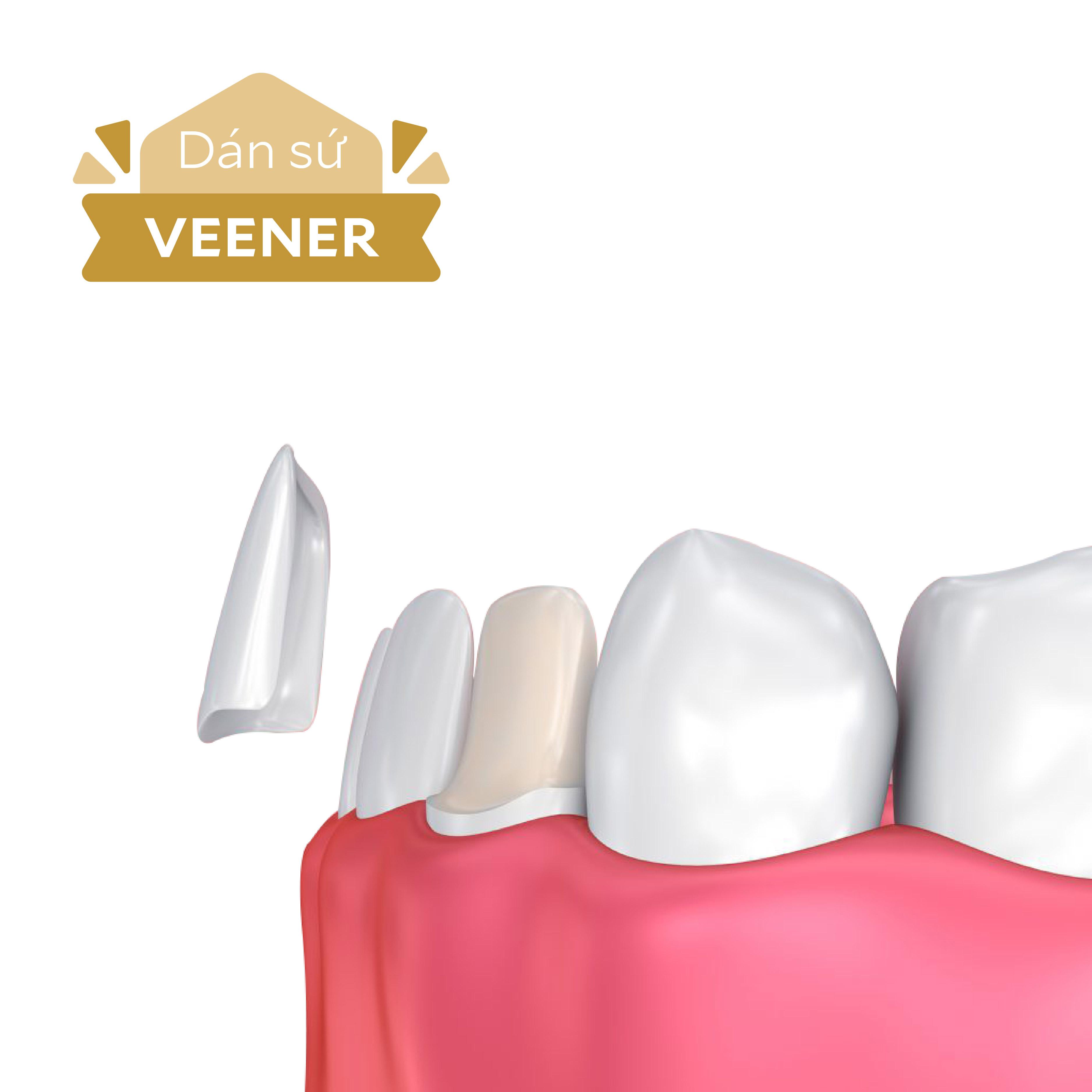 Phương pháp này thích hợp cho các trường hợp răng sậm màu, ố vàng, răng bị mòn, vỡ nhưng chưa quá 1/3 thân răng.