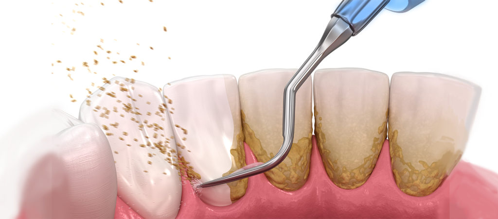Cần loại bỏ vôi răng: Ngăn ngừa vôi răng thế nào?