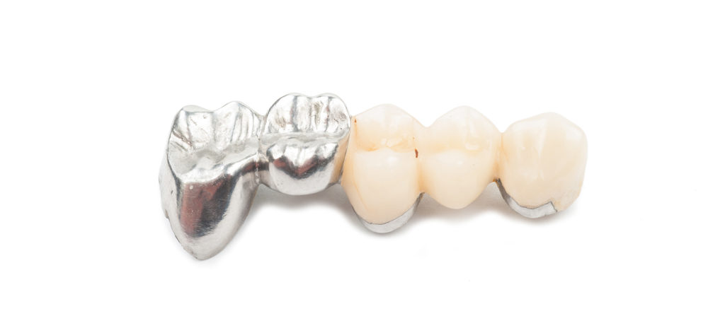 Kinh nghiệm bọc răng sứ: Cứu răng hô móm