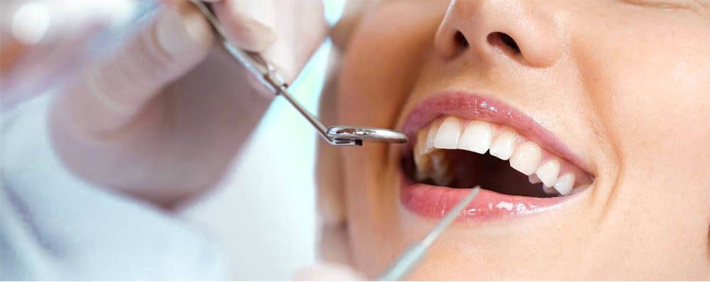 Giải pháp răng sứ thẩm mỹ: Hàm răng đều đẹp nhờ răng sứ