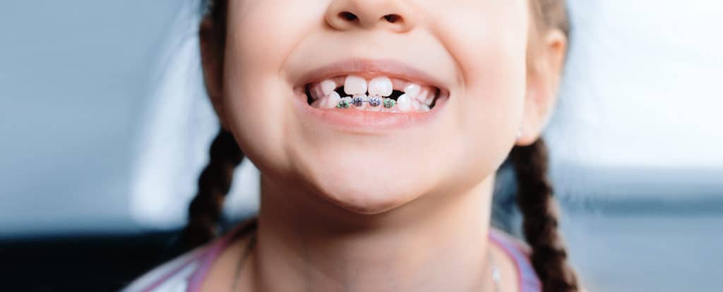Trẻ dễ sâu răng hư răng do đâu: Khắc phục răng bé mọc lệch