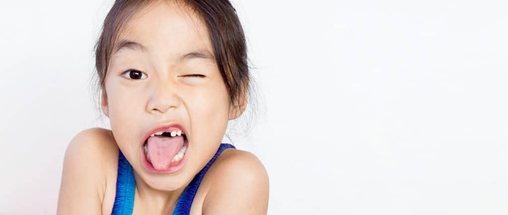 Trẻ dễ sâu răng hư răng do đâu: Khắc phục răng bé mọc lệch