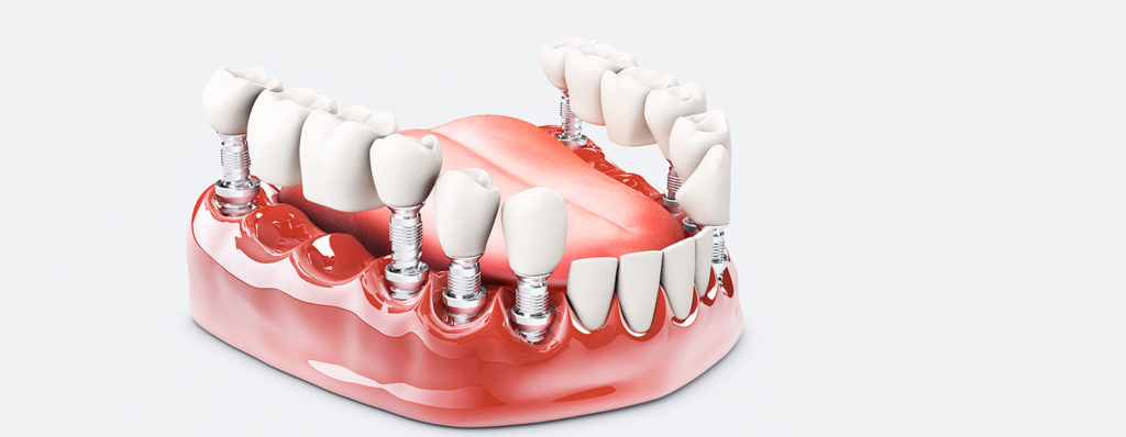 Giải pháp trồng răng implant: Không lo răng hư nhờ implant