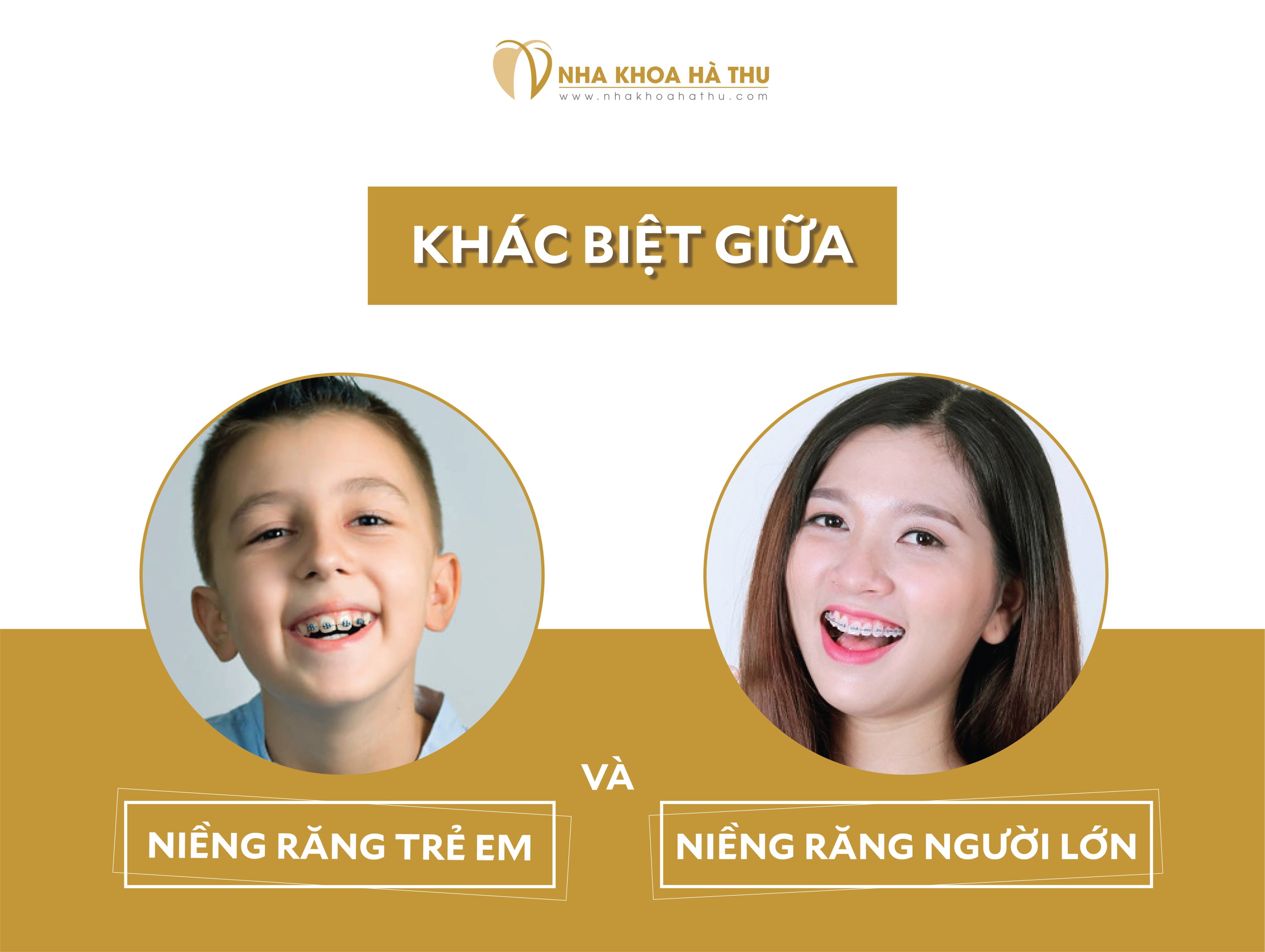 Sự khác biệt giữa niềng răng Trẻ em và Người lớn