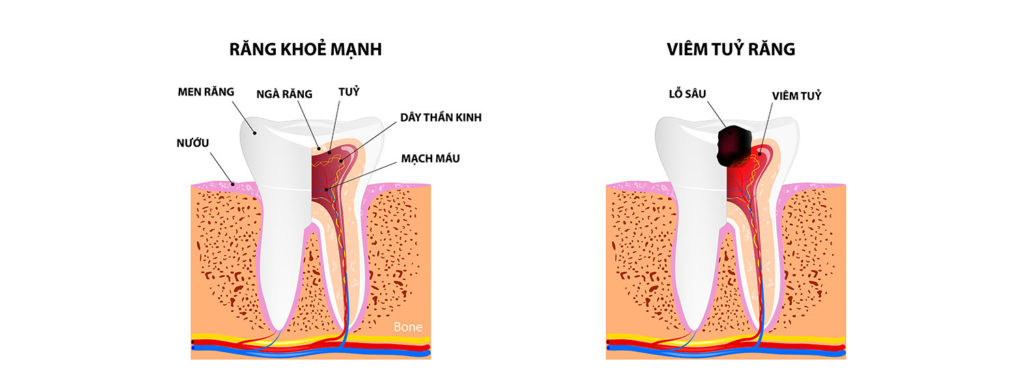 Nỗi lo viêm tủy răng: Hậu quả viêm tủy mất răng