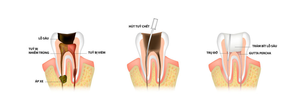 Nỗi lo viêm tủy răng: Hậu quả viêm tủy mất răng