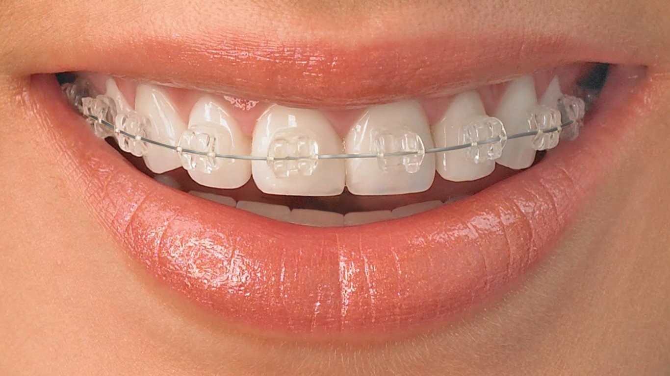 Niềng răng mắc cài sứ giống với phương pháp niềng răng hiệu quả truyền thống ở chỗ, sử dụng hệ thống mắc cài và dây cung để kéo răng về đúng vị trí trên hàm.