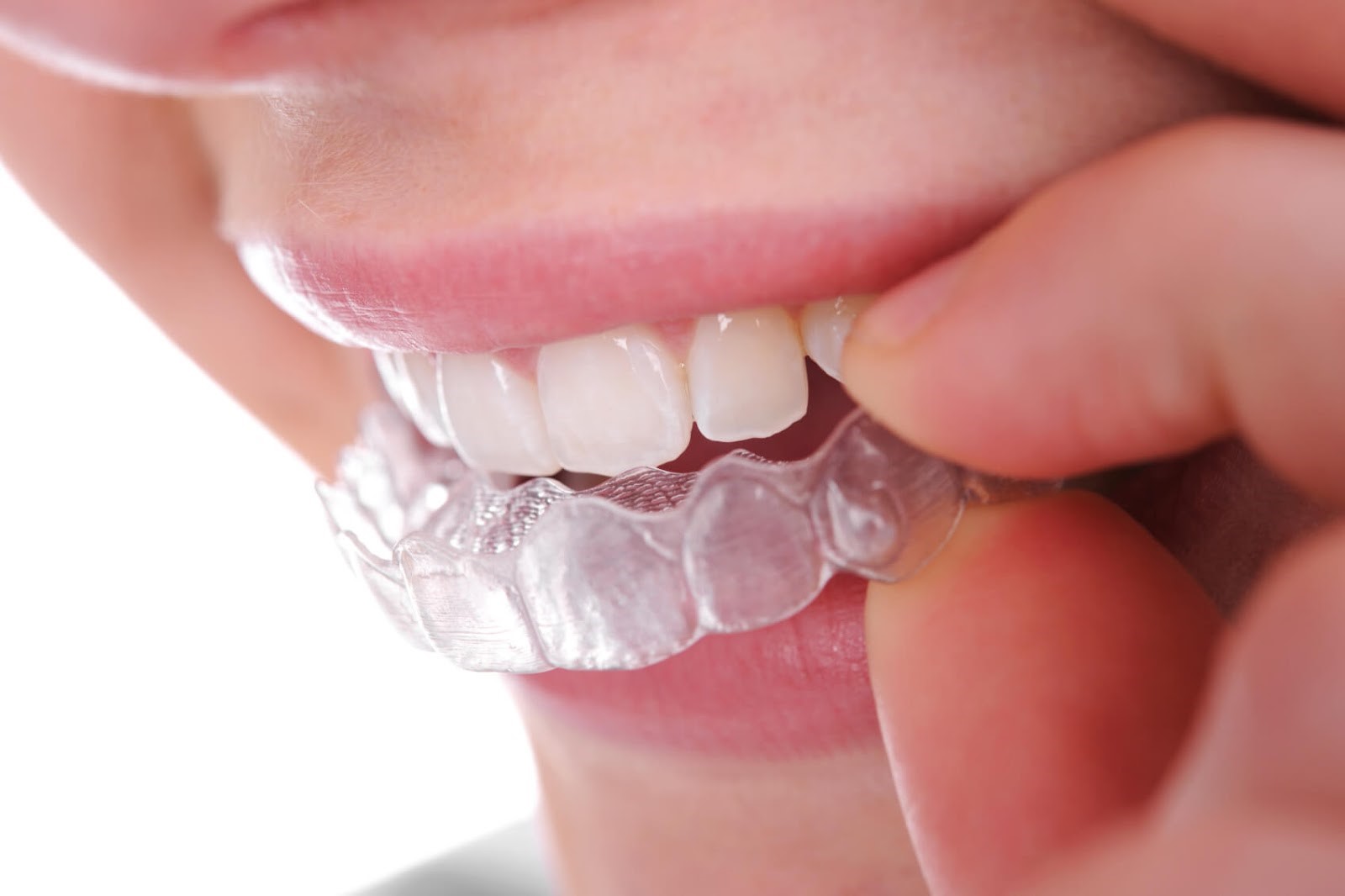 Khay niềng Invisalign trong suốt hay còn gọi là niềng răng trong suốt Invisalign, là phương pháp niềng răng hiệu quả, sử dụng khay được làm bằng nhựa trong suốt để tác động lực kéo liên tục, đưa răng di chuyển từ từ đến vị trí đều đặn trên cung hàm.