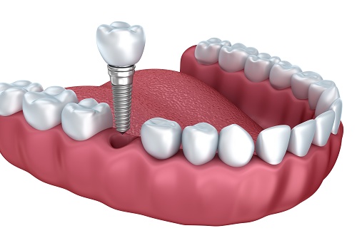 Tuy có giá hơi cao hơn nhưng Implant và cầu răng tạo cảm giác gần giống với cảm giác của răng thật hơn hàm giả tháo lắp.