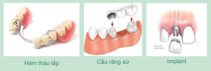 Hàm giả tháo lắp không còn là cách duy nhất để tái tạo răng mất đối với trường hợp còn ít răng hoặc không còn răng