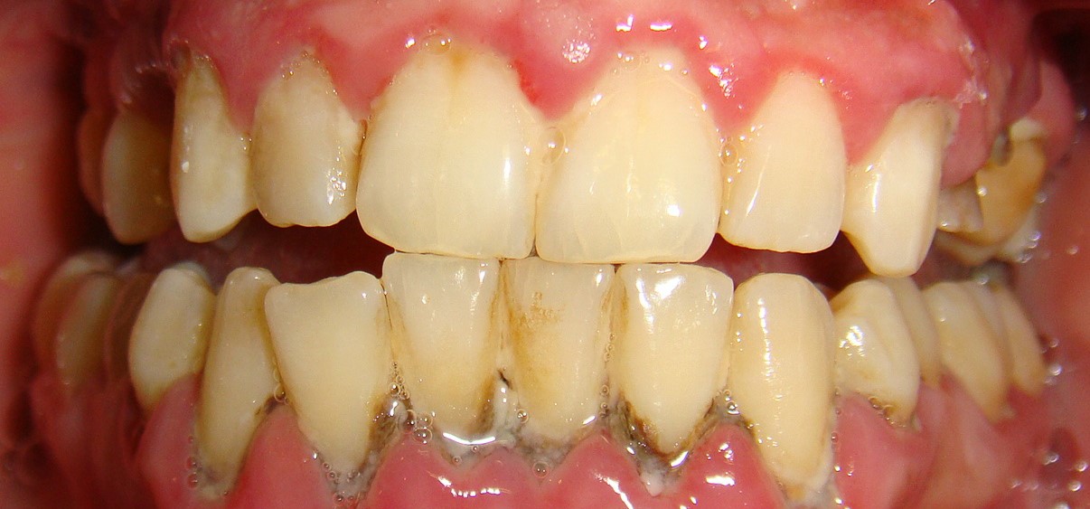 Bệnh nha chu, hay còn gọi là bệnh nướu, là sự viêm nhiễm mãn tính của nướu và mô quanh răng