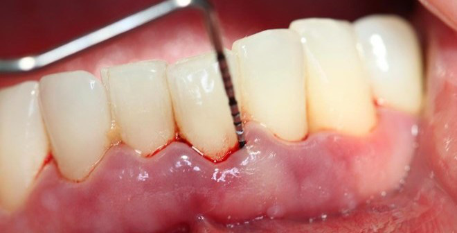 Những giai đoạn sớm, điều trị bệnh nha chu phổ biến nhất là cạo vôi răng và cạo láng gốc răng để lấy mảng bám và vôi quanh răng làm sạch và sáng các bề mặt chân răng. 