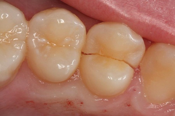 Cấp cứu trong Nha Khoa cho răng bị nứt gãy