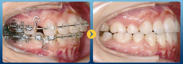 Nha sĩ sẽ tiến hành điều trị chỉnh hình răng cho bạn