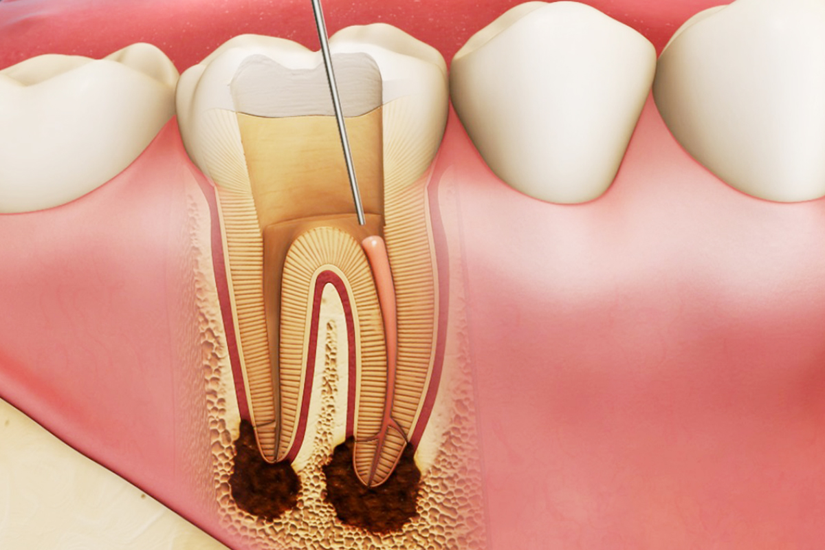 Điều trị tuỷ răng là gì