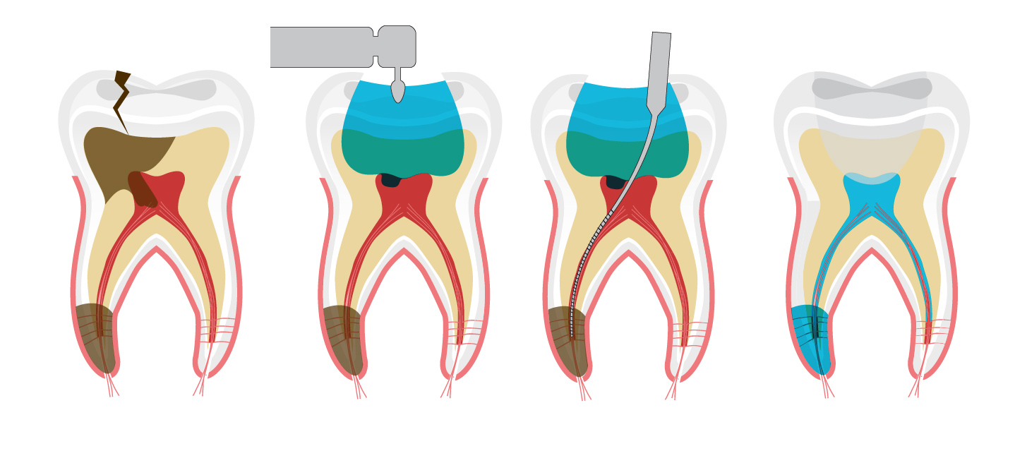 Các bước điều trị tủy răng?