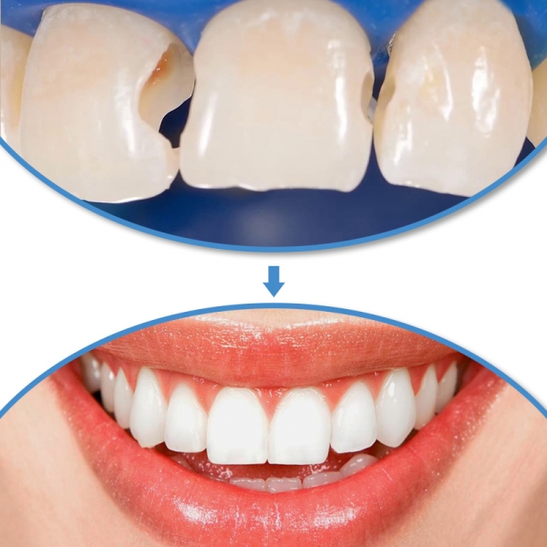 Trám răng thẩm mỹ Composite sẽ tồn tại bao lâu?